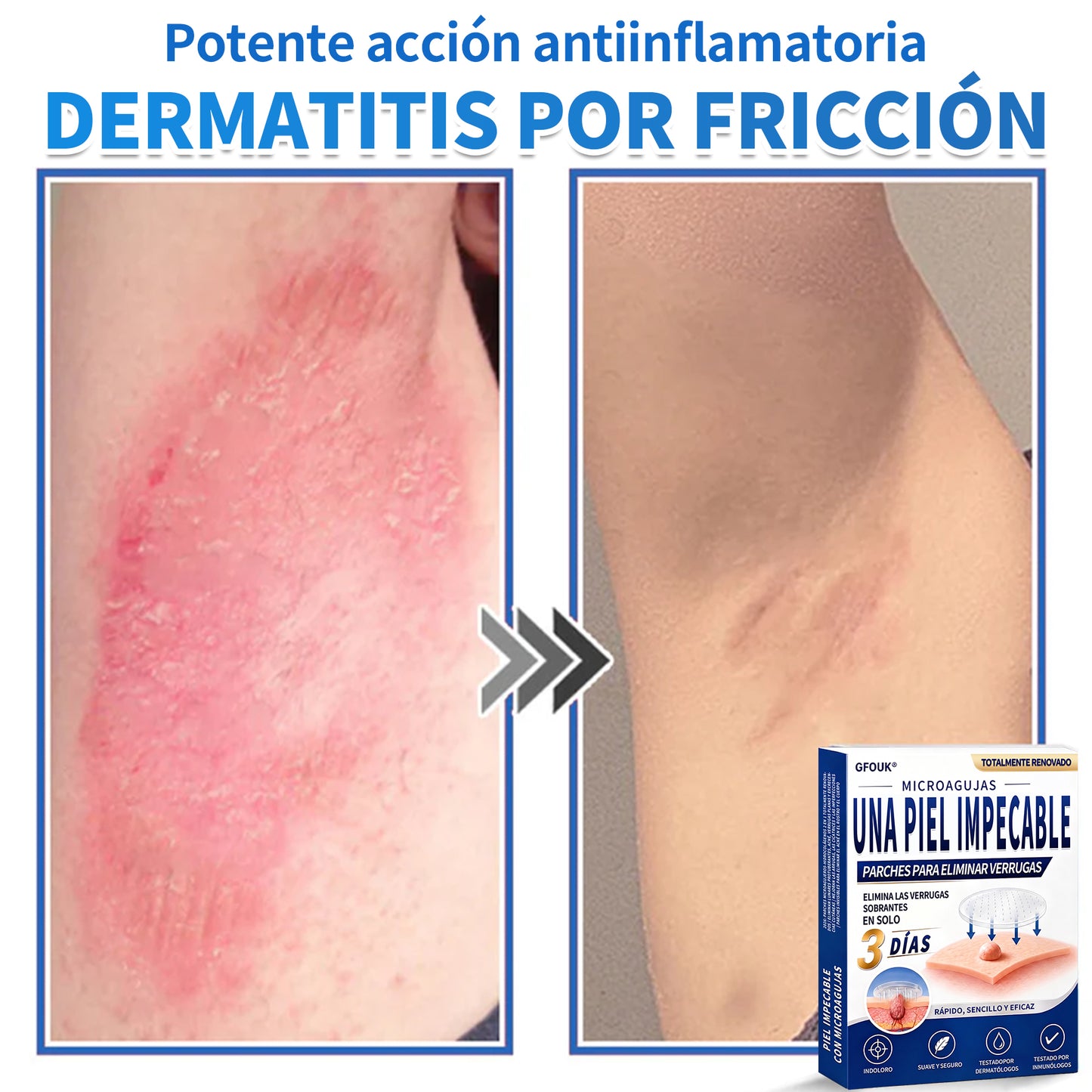 🔥GFOUK® 2026 Parche hidrocoloide de microagujas 2 en 1 versión mejorada | Elimina lunares elevados, acné y verrugas planas | Mejora arrugas, cicatrices e imperfecciones | Parches antiacné invisibles para rostro y cuerpo