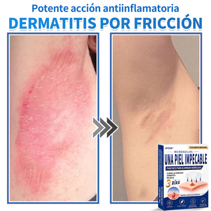 🔥GFOUK® 2026 Parche hidrocoloide de microagujas 2 en 1 versión mejorada | Elimina lunares elevados, acné y verrugas planas | Mejora arrugas, cicatrices e imperfecciones | Parches antiacné invisibles para rostro y cuerpo