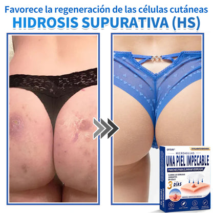 🔥GFOUK® 2026 Parche hidrocoloide de microagujas 2 en 1 versión mejorada | Elimina lunares elevados, acné y verrugas planas | Mejora arrugas, cicatrices e imperfecciones | Parches antiacné invisibles para rostro y cuerpo
