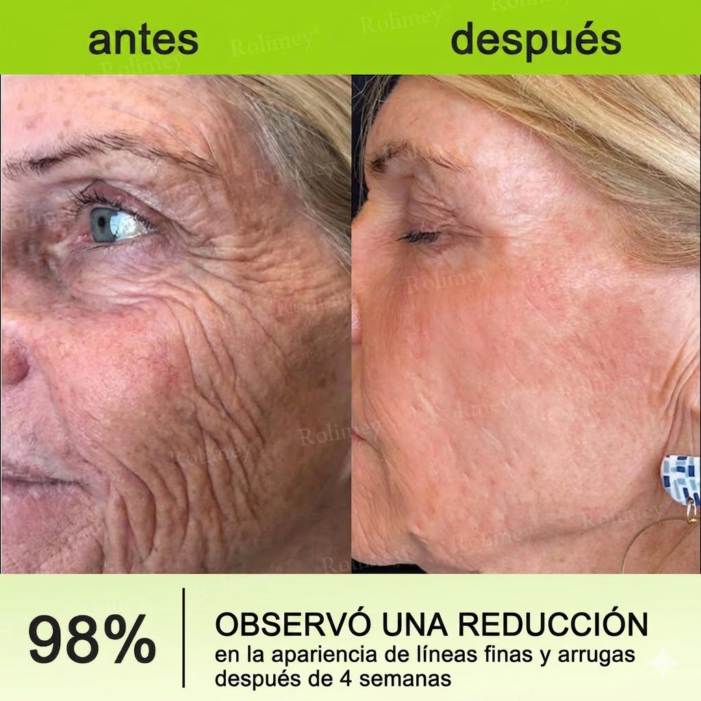 🔥Fabricado y enviado desde España💫Rolimey® Crema Inyectable Reductora de Arrugas y Reafirmante con Botox y Retinol - Último día de promoción, 30% de descuento