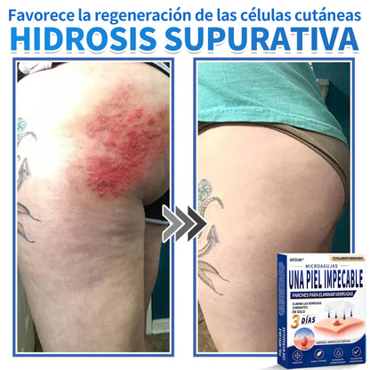 🔥GFOUK® 2026 Parche hidrocoloide de microagujas 2 en 1 versión mejorada | Elimina lunares elevados, acné y verrugas planas | Mejora arrugas, cicatrices e imperfecciones | Parches antiacné invisibles para rostro y cuerpo
