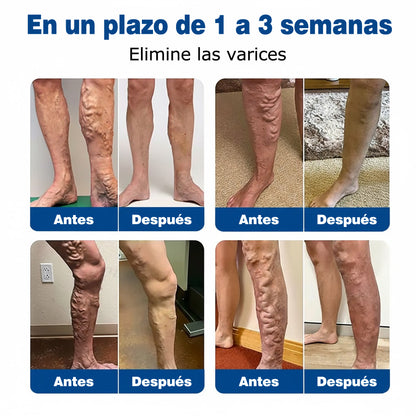🇪🇸👨‍⚕️✅Parche de microagujas GFOUK® VeinEase para el cuidado de las venas⚡Alivio instantáneo, resultados a largo plazo