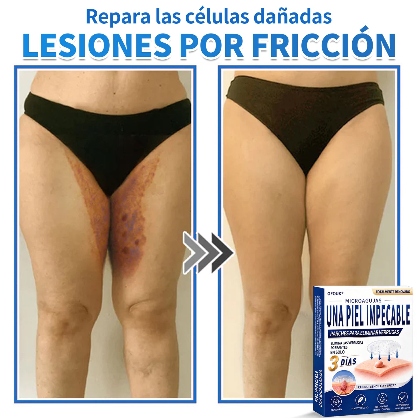 🔥GFOUK® 2026 Parche hidrocoloide de microagujas 2 en 1 versión mejorada | Elimina lunares elevados, acné y verrugas planas | Mejora arrugas, cicatrices e imperfecciones | Parches antiacné invisibles para rostro y cuerpo