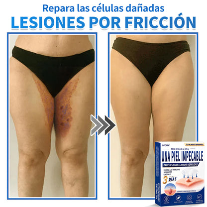 🔥GFOUK® 2026 Parche hidrocoloide de microagujas 2 en 1 versión mejorada | Elimina lunares elevados, acné y verrugas planas | Mejora arrugas, cicatrices e imperfecciones | Parches antiacné invisibles para rostro y cuerpo