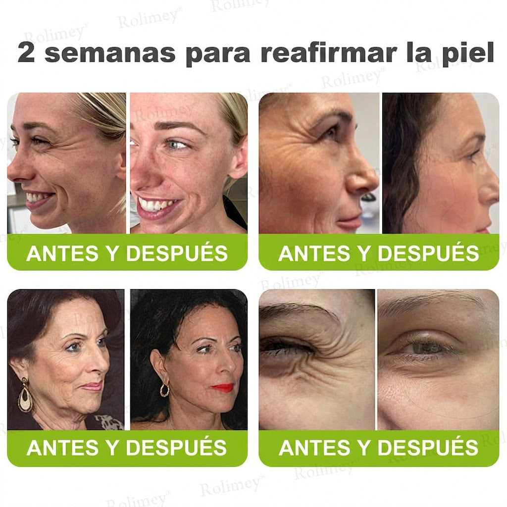 🔥Fabricado y enviado desde España💫Rolimey® Crema Inyectable Reductora de Arrugas y Reafirmante con Botox y Retinol - Último día de promoción, 30% de descuento
