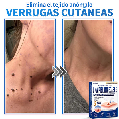 🔥GFOUK® 2026 Parche hidrocoloide de microagujas 2 en 1 versión mejorada | Elimina lunares elevados, acné y verrugas planas | Mejora arrugas, cicatrices e imperfecciones | Parches antiacné invisibles para rostro y cuerpo