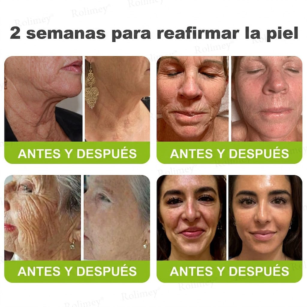 🔥Fabricado y enviado desde España💫Rolimey® Crema Inyectable Reductora de Arrugas y Reafirmante con Botox y Retinol - Último día de promoción, 30% de descuento
