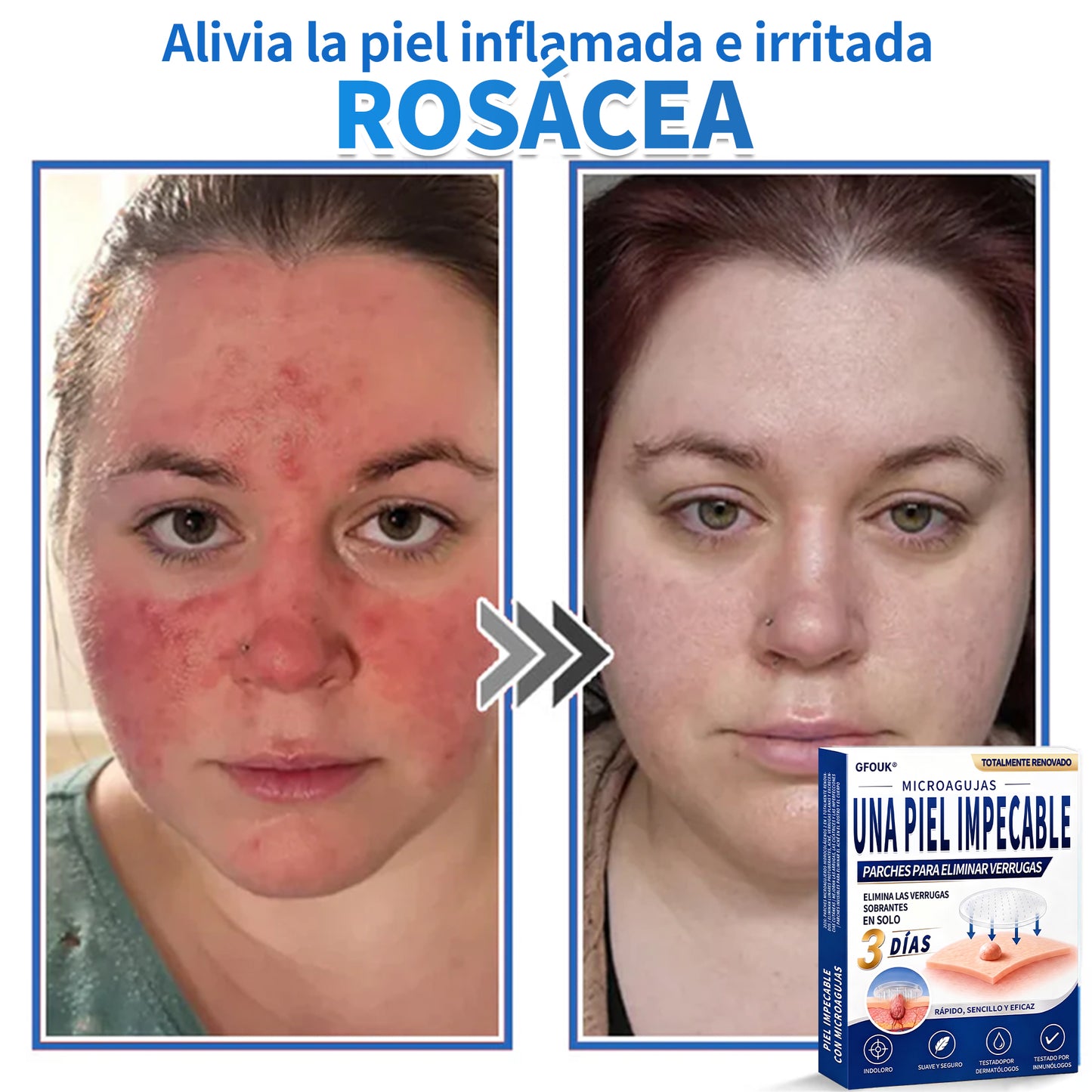 🔥GFOUK® 2026 Parche hidrocoloide de microagujas 2 en 1 versión mejorada | Elimina lunares elevados, acné y verrugas planas | Mejora arrugas, cicatrices e imperfecciones | Parches antiacné invisibles para rostro y cuerpo