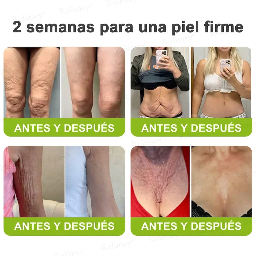 🔥Fabricado y enviado desde España💫Rolimey® Crema Inyectable Reductora de Arrugas y Reafirmante con Botox y Retinol - Último día de promoción, 30% de descuento