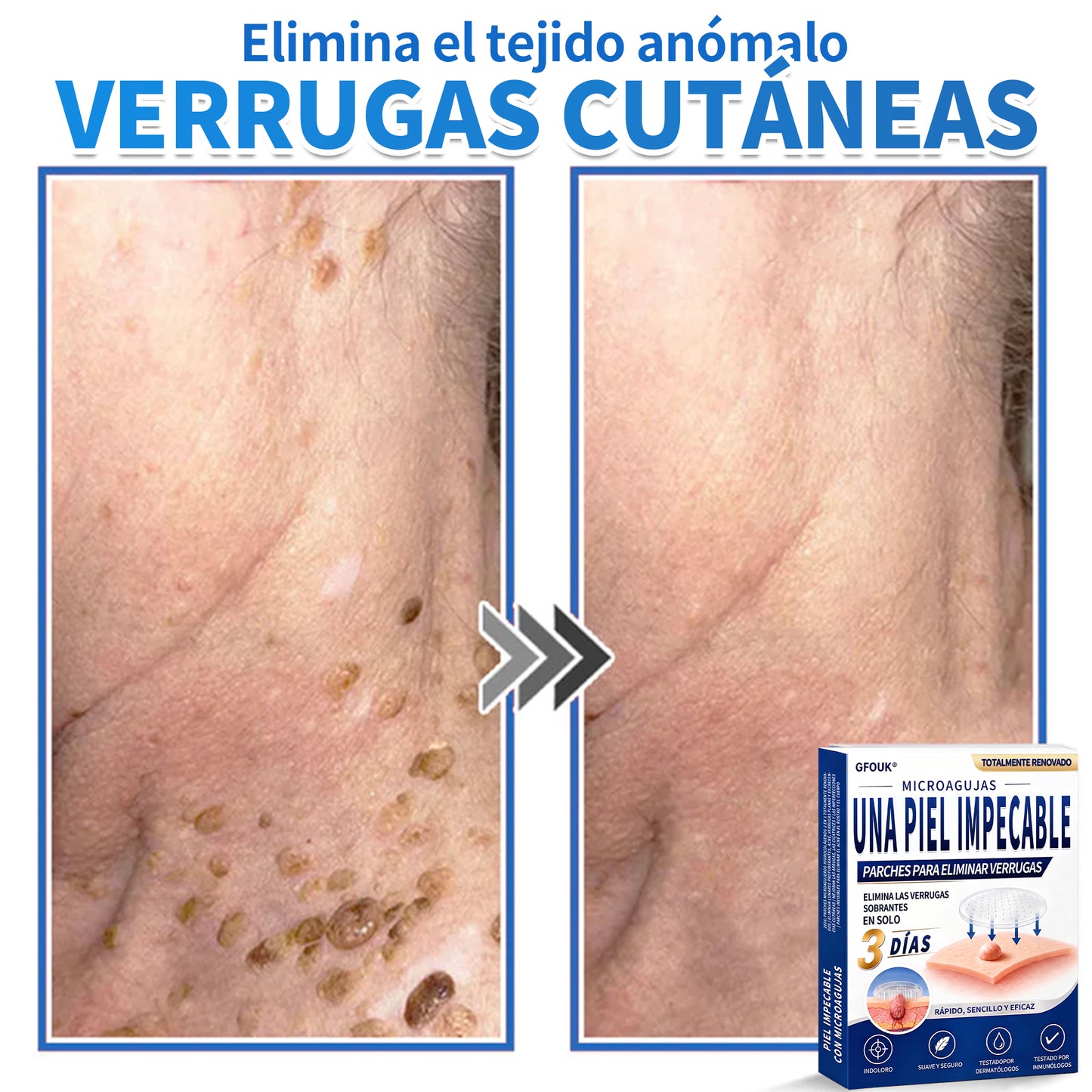 🔥GFOUK® 2026 Parche hidrocoloide de microagujas 2 en 1 versión mejorada | Elimina lunares elevados, acné y verrugas planas | Mejora arrugas, cicatrices e imperfecciones | Parches antiacné invisibles para rostro y cuerpo