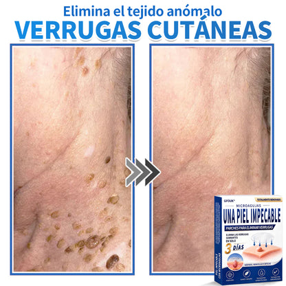 🔥GFOUK® 2026 Parche hidrocoloide de microagujas 2 en 1 versión mejorada | Elimina lunares elevados, acné y verrugas planas | Mejora arrugas, cicatrices e imperfecciones | Parches antiacné invisibles para rostro y cuerpo