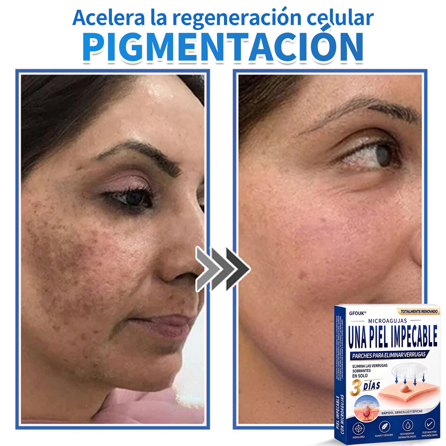 🔥GFOUK® 2026 Parche hidrocoloide de microagujas 2 en 1 versión mejorada | Elimina lunares elevados, acné y verrugas planas | Mejora arrugas, cicatrices e imperfecciones | Parches antiacné invisibles para rostro y cuerpo